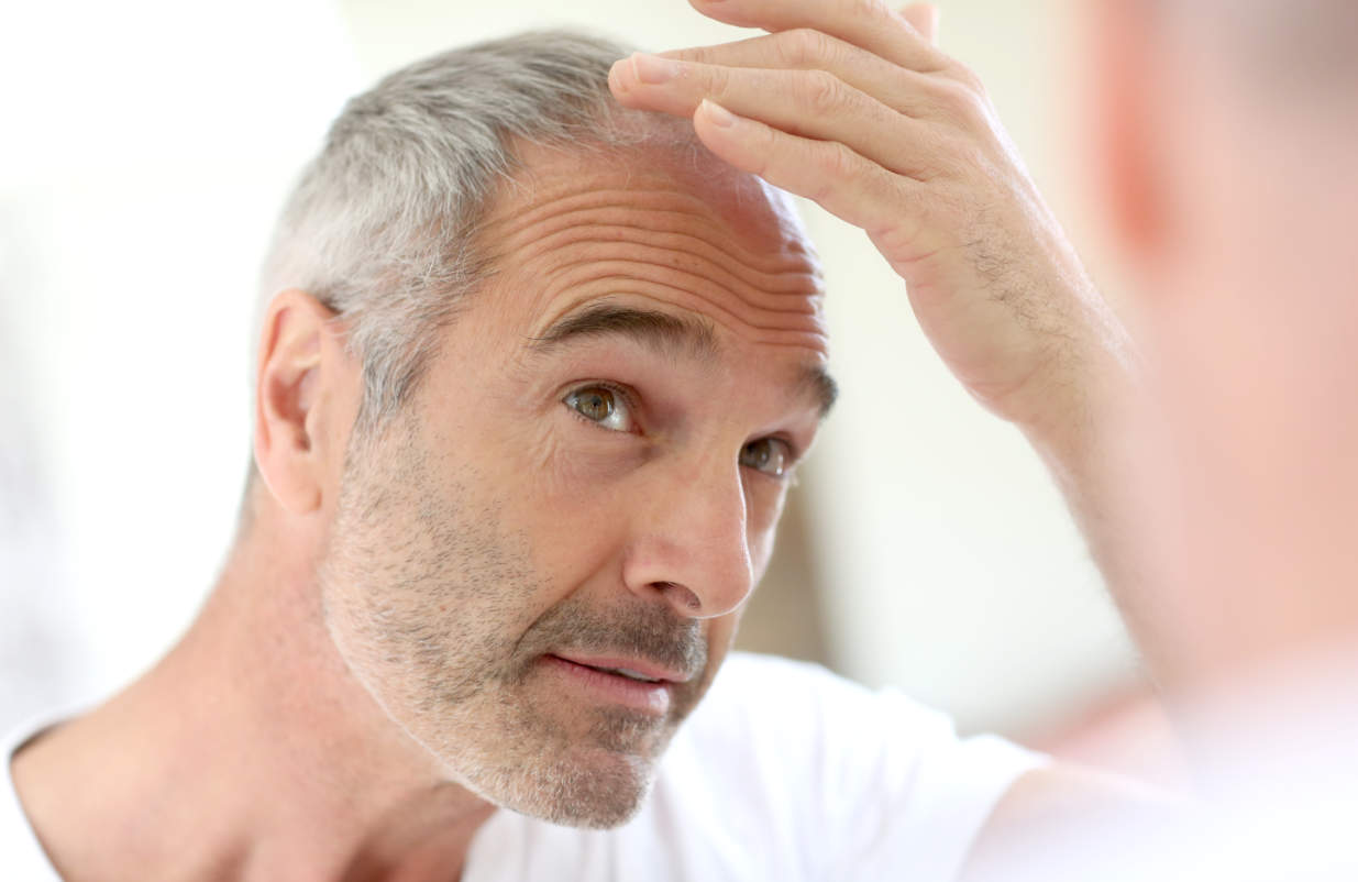 thinning-hair-restoration-kelowna