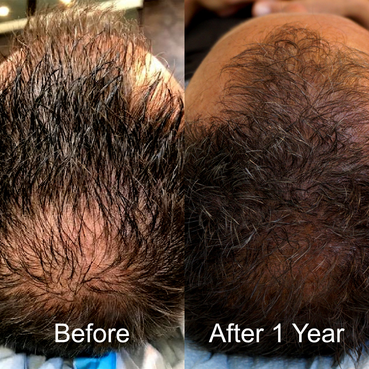 hair-restoration-before-after