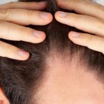 Young Men Are Turning to PRP for Hair Loss